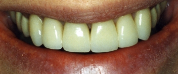 Cosmetic dentistry by a general dentist